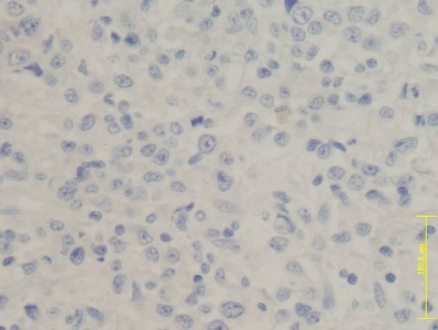 Fig.4: DLBCL. CD30 - <div style=